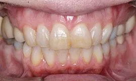 Cedar Rapids Tooth Whitening Example 1