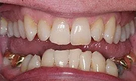 Cedar Rapid Teeth Whitening Example 1