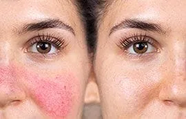 rosacea treatment before and after