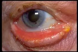 Ectropion