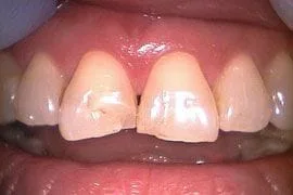 Cosmetic Crowns before