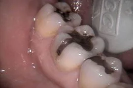 Fillings and CEREC - Before