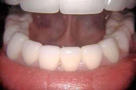 Bottom teeth cosmetic crowns - after 