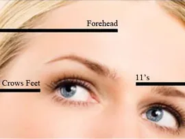 BOTOXÂ® Cosmetic