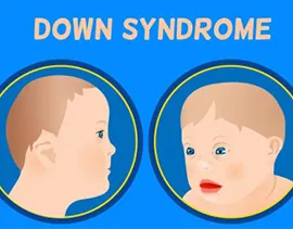 Oculomotor Dysfunction Down Syndrome