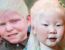 Pediatric Neuro-Ophthalmic Disorders Retinopathy of Prematurity - Albinism