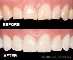 Before and after images of teeth with veneers Littleton, CO cosmetic dentist