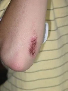 abrasion on elbow (3 days old)