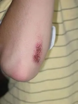 <strong>
</picture>Abrasion on Elbow (3 Days Old)</strong> <p>This scrape (abrasion) near the elbow occurred 3 days ago. The picture shows a scrape that is starting to crust over. </p><p>There are no signs of infection (such as spreading redness, pus).</p>