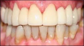 Restoration of upper teeth using laminates - Dentistry by Dr. Dean Sophocles