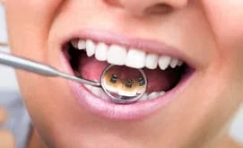 woman's open mouth, dental mirror reflecting lingual braces on back of teeth, orthodontics Lawrenceville, GA orthodontist