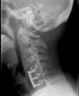 Cervical Fusion