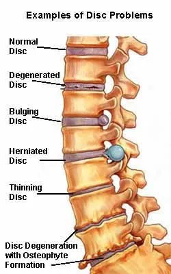 osteophyte formation lumbar spine