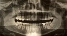 Dental X-Rays Stamford CT