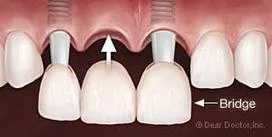 illustration of dental bridge being placed in mouth over implants to replace missing tooth, cosmetic dentistry Melrose, MA dentist
