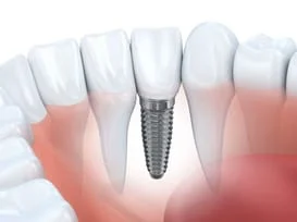 illustration of natural teeth and roots in gums, with one embedded implant, implant dentistry Somerville, MA dental implants