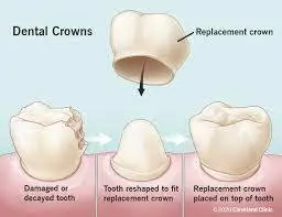 Illustration of process for Dental Crowns application