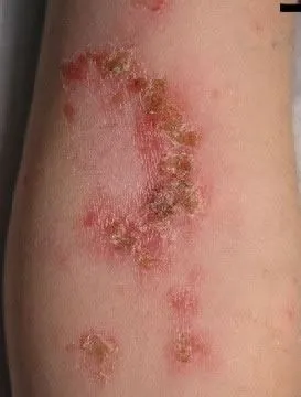 <strong>
</picture>Impetigo of Elbow</strong> <p>This shows impetigo on the elbow. Impetigo is a skin infection caused by bacteria. The infection causes a red sore which leaks fluid. This area will then dry and become crusty as it heals.</p>