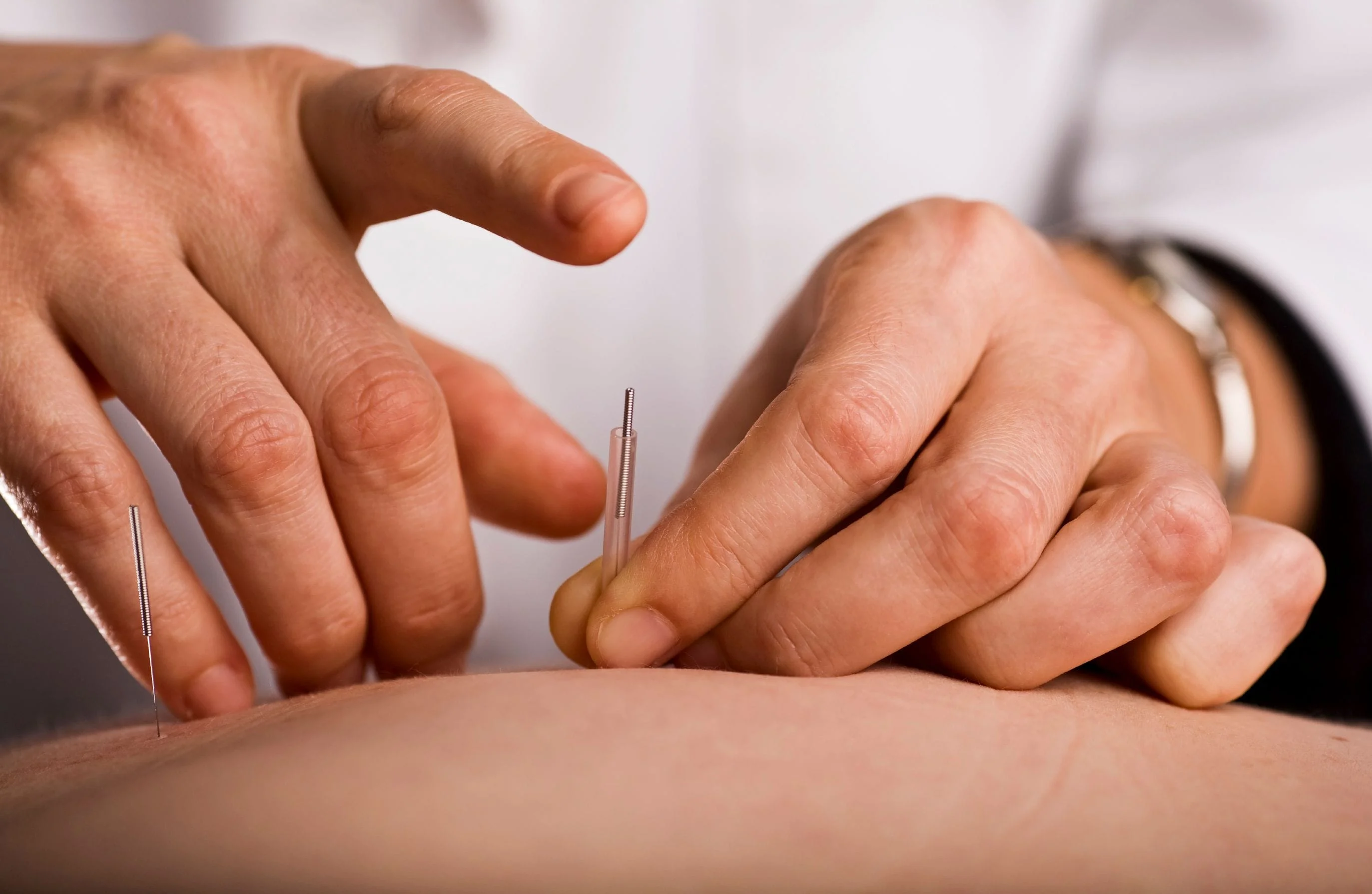 man receiving acupuncture for lower back pain at an acupuncture center in Staten Island