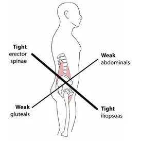 Lower X Syndrome, Lower Crossed Syndrome