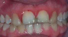 Before Teeth Whitening 2