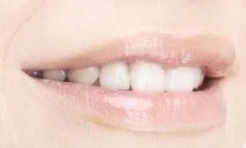 close up of a smile with dental inlays and onlays