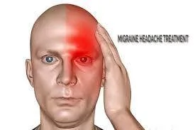Migraine Headache