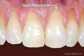gum recession