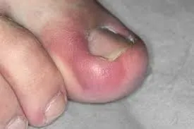 Ingrown toenail