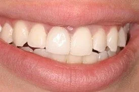 Veneer to alter color on dark teeth