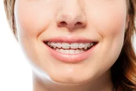 Traditional Braces in Scarborough, ON