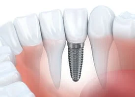 illustration of embedded dental implant in jaw next to natural teeth, dental implants Baytown dentist