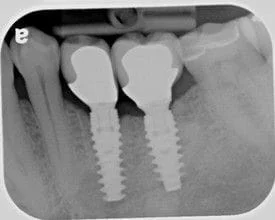 Dental Implants In Myrtle Beach, SC
