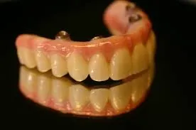 Implant Supported Denture