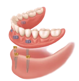 Stockton Dental Implants