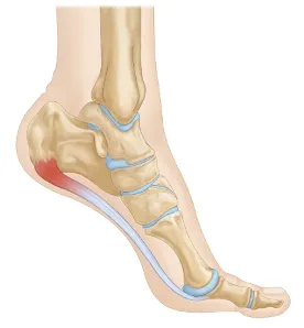 plantar fasciitis foot pain