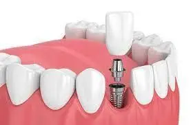 Dental Implants in New York, NY