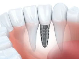 illustration of teeth and roots in gums, embedded dental implants Philadelphia, PA dentist
