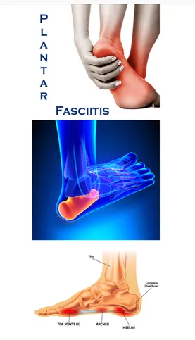 Plantar Fasciitis • Conway Podiatrist