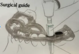 diagram showing surgical guide in place in mouth and dental drill creating hole for dental implants New Baltimore, MI dentist