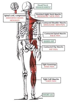 Pinched Nerve Valdosta GA, Tifton, Douglas, Nashville GA Chiropractic