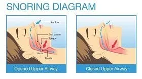 Snoring Diagram