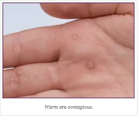 Viral warts - Dermatology & Co : Dermatology & Co