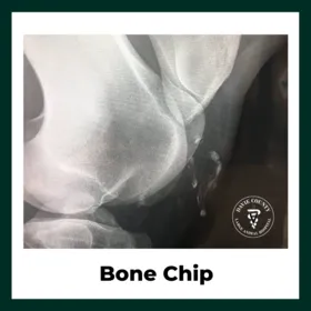 Bone Chio surgery