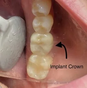 close up image inside patient's mouth showing placed dental implant with dental crown Placerville, CA dentist