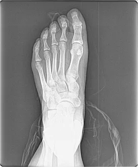 X-ray of foot