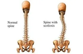 scoliosis_comparison.jpg