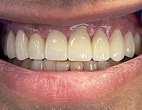 Broken & Chipped Tooth Repair Larchmont