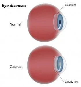 Eye Diseases