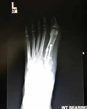 Lapidus bunion correction with large screw.